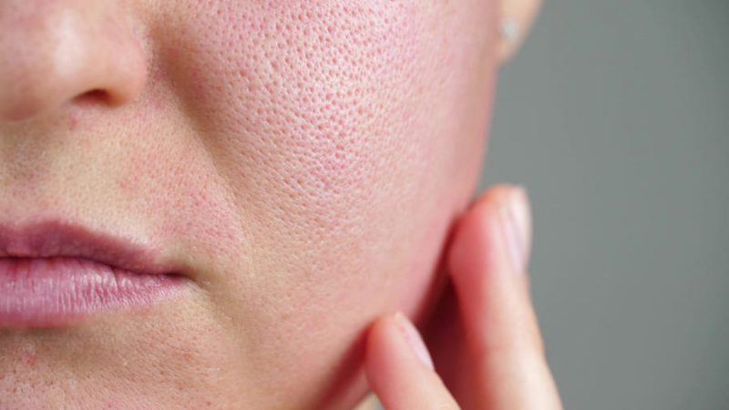 Diga adeus aos problemas de poros: Um guia passo a passo sobre como fechar os poros do seu rosto